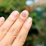 Perawatan Kuku Berjamur: Penyebab, Gejala, Cara Mengatasinya