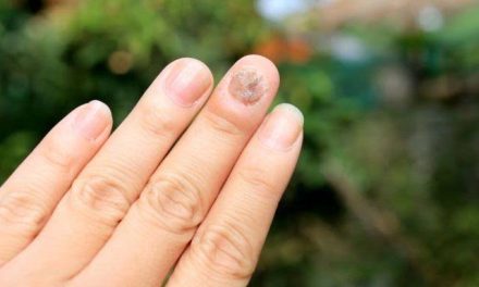 Perawatan Kuku Berjamur: Penyebab, Gejala, Cara Mengatasinya