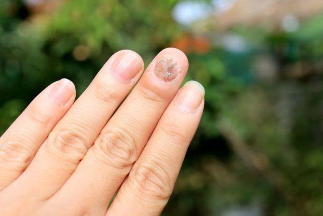 Perawatan Kuku Berjamur: Penyebab, Gejala, Cara Mengatasinya